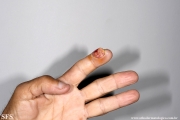 sporotrichosis
