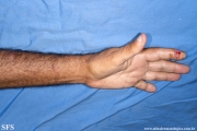 sporotrichosis
