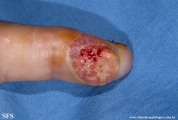 sporotrichosis