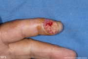 sporotrichosis