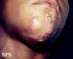 sporotrichosis