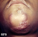 sporotrichosis