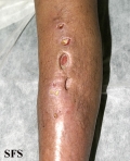 sporotrichosis