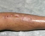 sporotrichosis