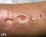 sporotrichosis