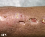 sporotrichosis