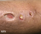 sporotrichosis