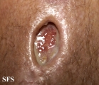 sporotrichosis