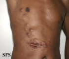 sporotrichosis