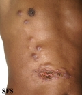 sporotrichosis