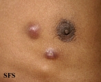 sporotrichosis