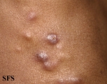 sporotrichosis