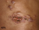 sporotrichosis