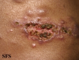 sporotrichosis