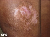 mixed connective tissue disease