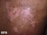 mixed connective tissue disease