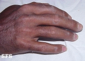 mixed connective tissue disease
