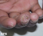 mixed connective tissue disease
