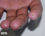 mixed connective tissue disease