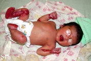 epidermolysis bullosa and pseudomonas infection