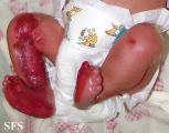epidermolysis bullosa and pseudomonas infection