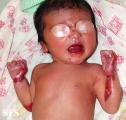 epidermolysis bullosa and pseudomonas infection