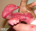 epidermolysis bullosa and pseudomonas infection