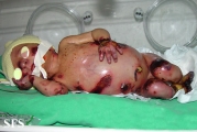 epidermolysis bullosa and pseudomonas infection