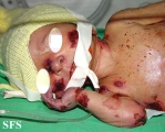 epidermolysis bullosa and pseudomonas infection
