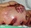 epidermolysis bullosa and pseudomonas infection