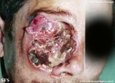 idiopathic midline destructive disease