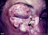 idiopathic midline destructive disease