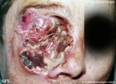 idiopathic midline destructive disease