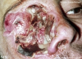 idiopathic midline destructive disease