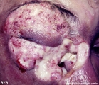 idiopathic midline destructive disease