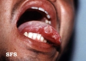 behçet's syndrome