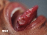 behçet's syndrome