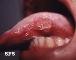behçet's syndrome