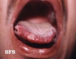 behçet's syndrome