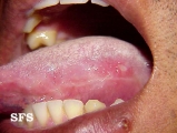 behçet's syndrome