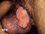 behçet's syndrome