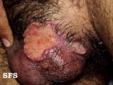 behçet's syndrome