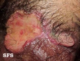 behçet's syndrome