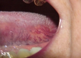 behçet's syndrome