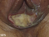 behçet's syndrome