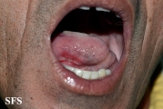 behçet's syndrome