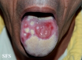 behçet's syndrome
