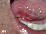 behçet's syndrome