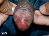 behçet's syndrome