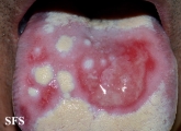 behçet's syndrome
